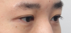 What Type of Plastic Surgery Is Needed for Small, Cramped Eyes? (About Lateral, Lower, and Combined Lateral-Lower Canthoplasty) image 11