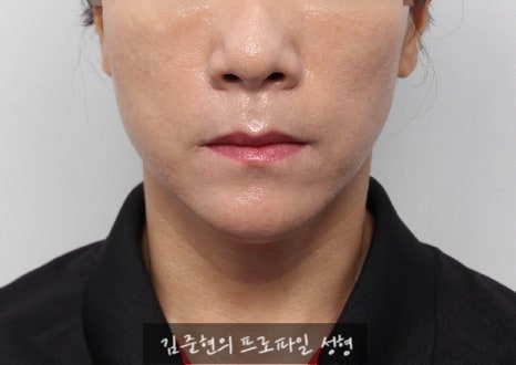 수술없이 간단하게 안면비대칭, 턱끝 비대칭(미드라인 맞추기) 해결하기!! 관련 이미지 8