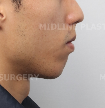 A Plastic Surgeon Explains the Changes in the Front and Side Views After Reduction Genioplasty and Advancement Genioplasty. (Feat. Rhinoplasty) image 6