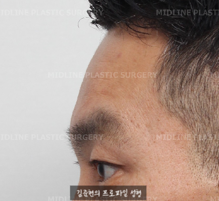 쌍꺼풀을 하려는데 이마주름이 심각해요....어떡하죠? 상남자의 자연스런 쌍꺼풀 만들기(Feat. 내시경 이마거상) 관련 이미지 9