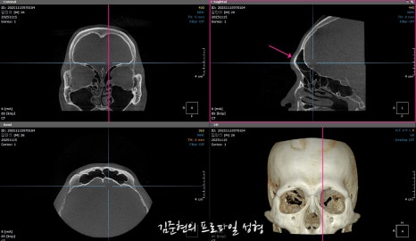 눈썹뼈절삭, 어떨 때 어떻게 하는 수술일까요? 꼭 이마거상과 함께 해야만 하는 수술인가요? 미드라인성형외과에서 하는 눈썹뼈절삭 수술을 설명드립니다. (3D CT 있음) 관련 이미지 6