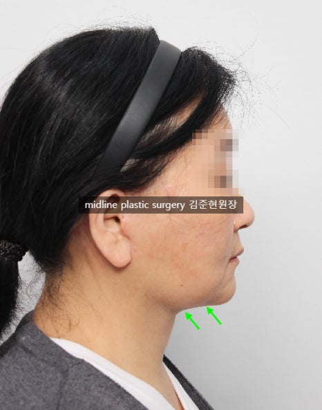 안면거상 흉터를 보여주는 곳은 없어서 미드라인성형외과가 보여드립니다. (feat. 심부볼리프팅) 관련 이미지 13