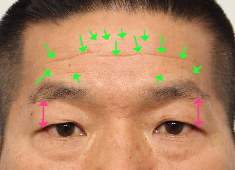 When Should Endoscopic Forehead Lift and Brow Lift Be Performed at the Same Time? (Feat. Lower Blepharoplasty) image 5