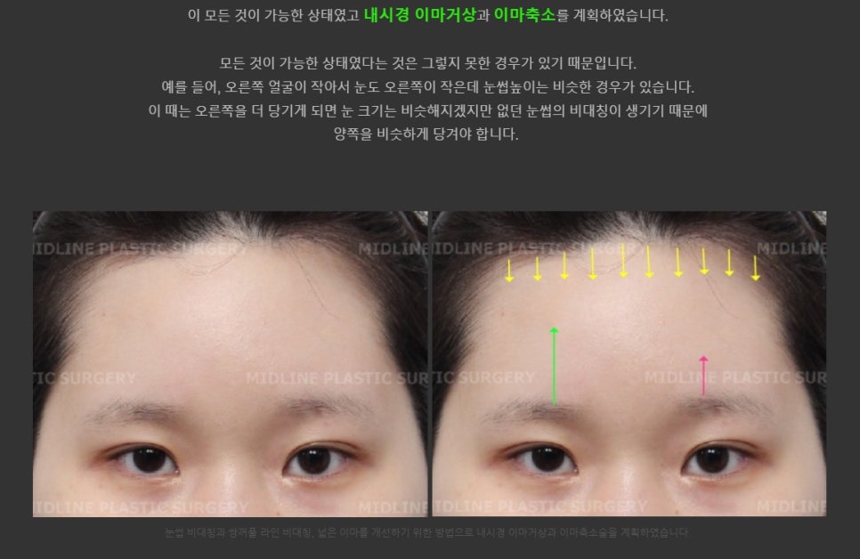 눈썹비대칭(짝눈썹)과 짝눈 바로 잡기! 내시경 이마거상으로 가능합니다.  2탄! 관련 이미지 1