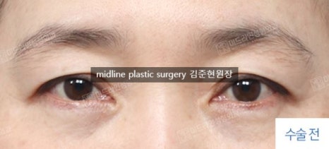 Forehead lift for people in their 20s and 30s: correcting eyelid sagging and even eye asymmetry! image 5