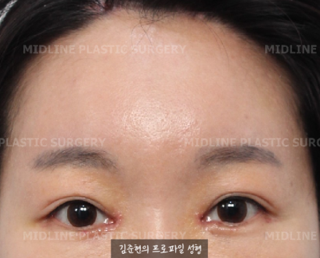Because of the Mongolian fold, the eyes look cramped — epicanthoplasty can fix it. (Feat. Endoscopic forehead lift) image 13