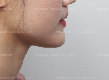 Fixing a Sagging Double Chin After Contouring Surgery! Let’s Learn About Mid-Up Lifting 2040. image 1