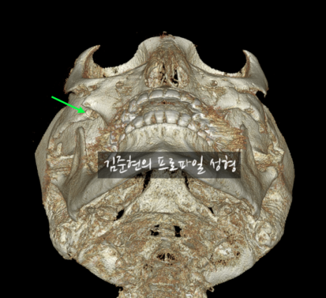 퀵광대 부작용으로 인한 광대 비대칭이 생겼어요. 어떡하죠? 성형외과 전문의가 설명드립니다. 관련 이미지 3