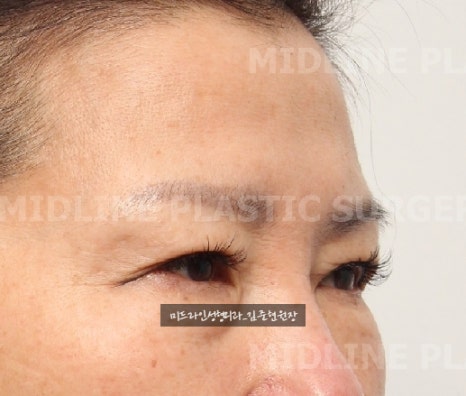 콧등 보톡스로 해결할 수 없는 콧등 가로주름!! 근본적인 해결에 대하여 알려드립니다. 관련 이미지 9