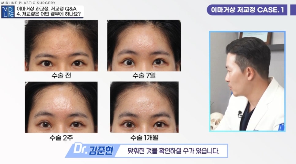 눈썹비대칭(짝눈썹)과 짝눈 바로 잡기! 내시경 이마거상으로 가능합니다.  2탄! 관련 이미지 6