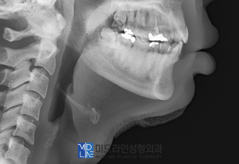 A Plastic Surgery Specialist Explains Why Chin Liposuction Is Sometimes Essential Because Jaw Reduction Surgery Alone Has Limited Effect image 11