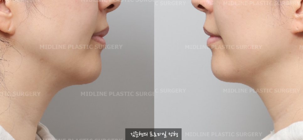 이중턱이 고민이에요ㅠㅠ숨은 턱선을 찾아주는 이중턱, 턱라인 지방흡입! 미드업 2040에 관하여 설명드립니다. 관련 이미지 8