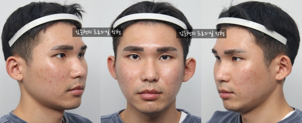 45도 광대와 옆광대를 모두 줄이는 광대축소술을 성형외과 전문의가 알려드립니다. 관련 이미지 12