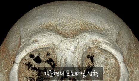 Let’s Learn About the Effects of Brow Bone Reduction Surgery. (Brow Bone? Eye Hole Bone? Here’s a Terminology Guide.) image 7