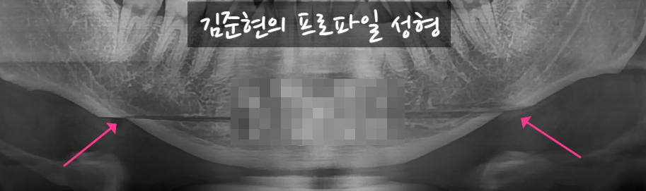 턱끝전진술로 생긴 이차각은 어떻게 되나요?! 관련 이미지 7