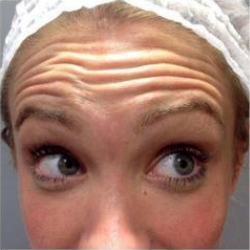 When Should Endoscopic Forehead Lift and Brow Lift Be Performed at the Same Time? (Feat. Lower Blepharoplasty) image 3