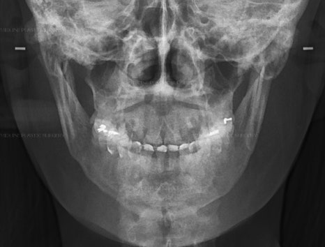 Fixing Sagging After Facial Contouring Surgery with a Face Lift!! (Feat. Plate Removal, Plate & Screw Removal) image 13