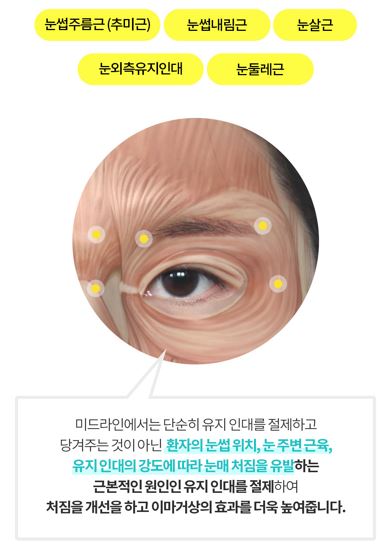 멀티 내시경이마거상술 vs 일반 이마거상술 차이점! 관련 이미지 10