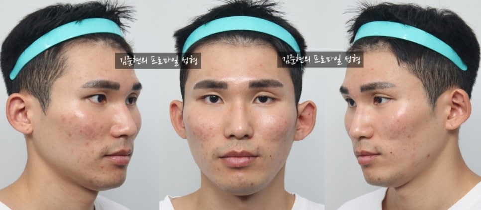 45도 광대와 옆광대를 모두 줄이는 광대축소술을 성형외과 전문의가 알려드립니다. 관련 이미지 11