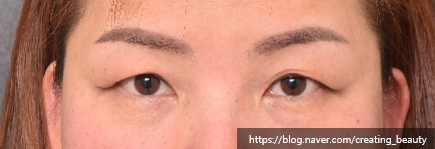 눈썹하거상술(Subbrow lift, Sub-browpexy)이 필요한 경우를 성형외과 전문의가 설명해 드립니다. 관련 이미지 6