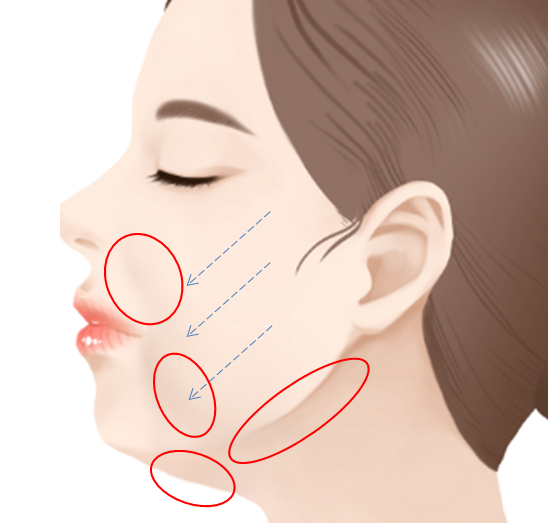 Fixing Sagging After Facial Contouring Surgery with a Face Lift!! (Feat. Plate Removal, Plate & Screw Removal) image 2