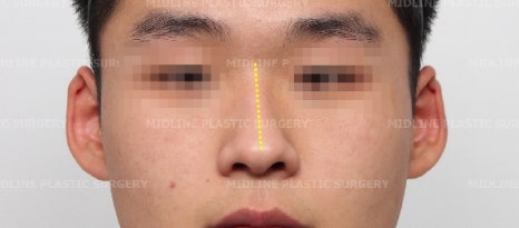휜 코, 매부리 교정과 기능코-비중격만곡증까지 바로잡기 관련 이미지 3