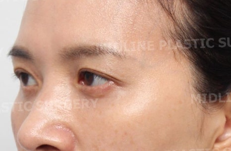 눈두덩이 꺼짐을 해결할 수 있는 눈꺼풀 지방이식! 성형외과 전문의가 설명드립니다. 관련 이미지 13