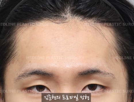 눈썹뼈절삭, 어떨 때 어떻게 하는 수술일까요? 꼭 이마거상과 함께 해야만 하는 수술인가요? 미드라인성형외과에서 하는 눈썹뼈절삭 수술을 설명드립니다. (3D CT 있음) 관련 이미지 3
