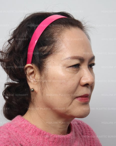 얼굴 주름 리프팅, 오래 지속되고 효과 좋은 수술방법은? 관련 이미지 11