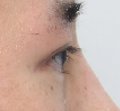 What Type of Plastic Surgery Is Needed for Small, Cramped Eyes? (About Lateral, Lower, and Combined Lateral-Lower Canthoplasty) image 15