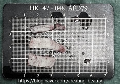 코 수술 후 코가 막힌다는 증상으로 온 환자입니다. 해결 방법을 성형외과 전문의가 설명드립니다. 관련 이미지 10