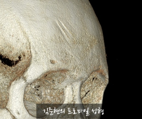 Let’s Learn About the Effects of Brow Bone Reduction Surgery. (Brow Bone? Eye Hole Bone? Here’s a Terminology Guide.) image 14