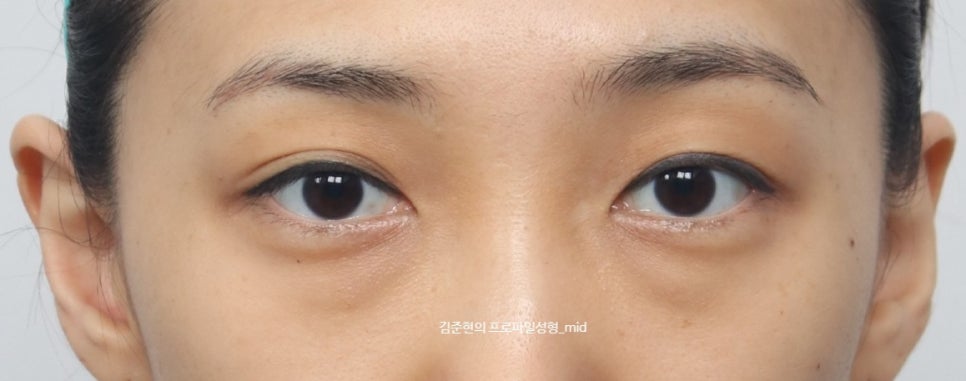 미드라인성형외과 김준현원장이 알려주는 눈밑지방재배치와 눈밑지방이식. 관련 이미지 1