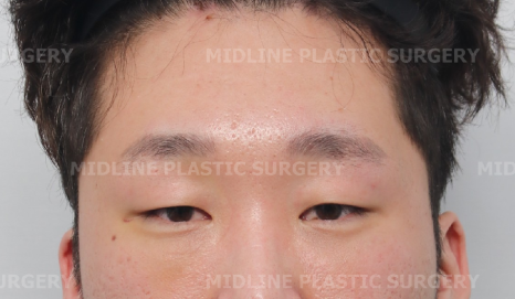 <2편> 쌍꺼풀 수술 없이 눈을 크게 만드는 방법을 성형외과 전문의가 직접 설명드립니다. 관련 이미지 8