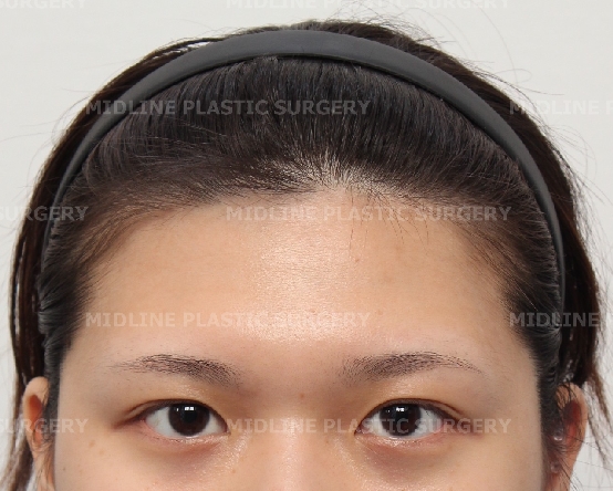 Forehead Lift for a Forehead with Prominent Brow Bones?? image 3