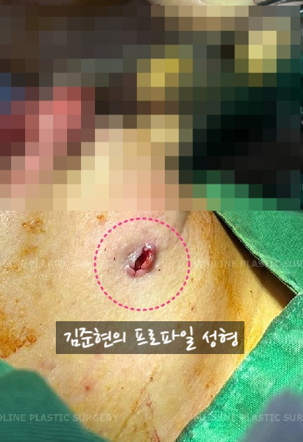 앞턱 보형물이 턱 옆으로 뚫고 나와요ㅠㅠ앞턱 보형물 제거 후 턱끝전진술을 한 케이스를 성형외과 전문의가 설명합니다. 관련 이미지 12