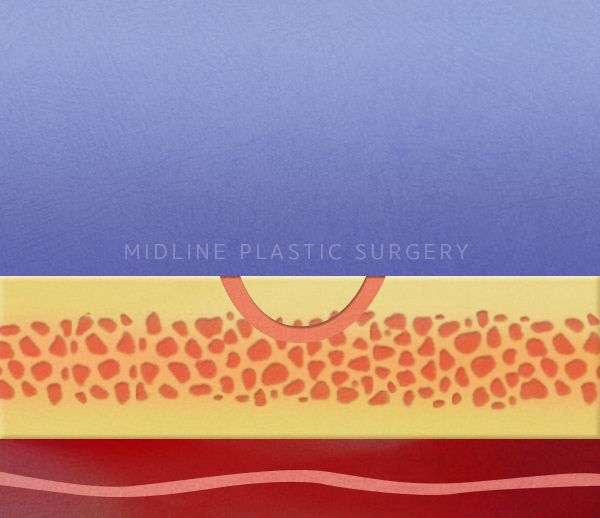 Forehead Lift! Endotine vs Absorbable Thread — Explaining the Differences in Results and Side Effects image 6