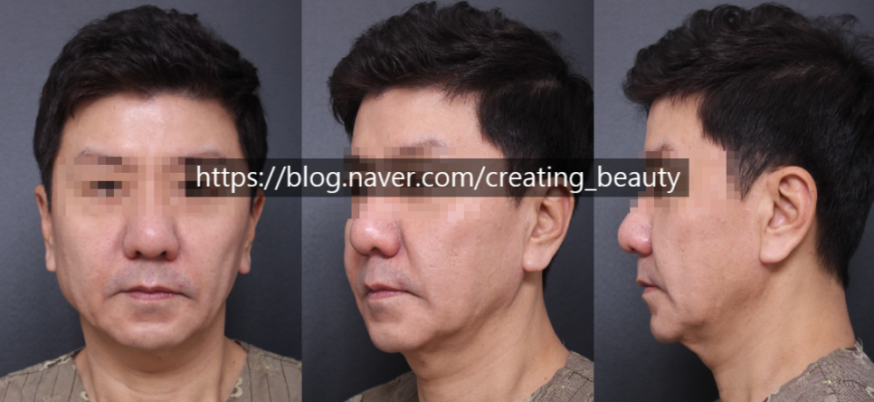 안면거상(Face lift, Rhytidectomy)에 대하여 성형외과 전문의가 알려드립니다. 관련 이미지 12