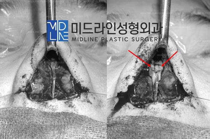 코막힘 원인, 비밸브재건술에 대하여 성형외과 전문의가 설명드립니다. 관련 이미지 8