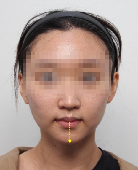 무턱 교정하면서 턱끝 비대칭(안면비대칭)까지 바로잡기! 관련 이미지 13