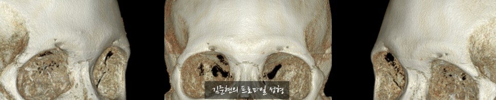 "아이홀뼈가 튀어나와서 보기 싫어요. " 아이홀뼈 절삭에 관하여 성형외과 전문의가 설명드립니다. 관련 이미지 4