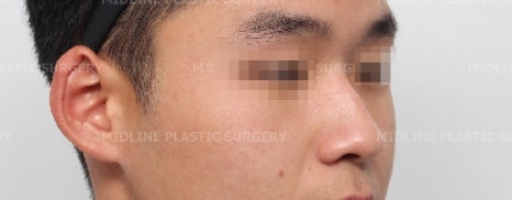 휜 코, 매부리 교정과 기능코-비중격만곡증까지 바로잡기 관련 이미지 6