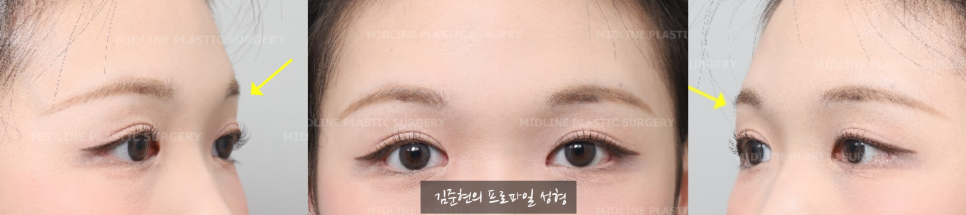 "아이홀뼈가 튀어나와서 보기 싫어요. " 아이홀뼈 절삭에 관하여 성형외과 전문의가 설명드립니다. 관련 이미지 8