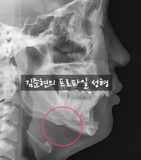 턱끝전진술로 생긴 이차각은 어떻게 되나요?! 관련 이미지 1
