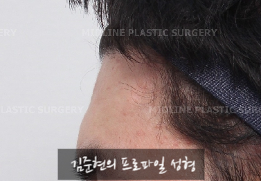 Let’s Learn About the Effects of Brow Bone Reduction Surgery. (Brow Bone? Eye Hole Bone? Here’s a Terminology Guide.) image 3