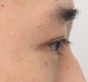 What Type of Plastic Surgery Is Needed for Small, Cramped Eyes? (About Lateral, Lower, and Combined Lateral-Lower Canthoplasty) image 12