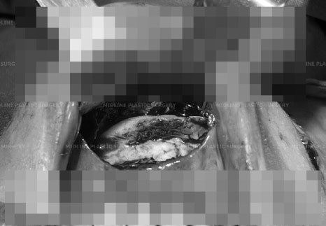 앞턱 보형물이 턱 옆으로 뚫고 나와요ㅠㅠ앞턱 보형물 제거 후 턱끝전진술을 한 케이스를 성형외과 전문의가 설명합니다. 관련 이미지 13