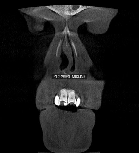 휜 코, 매부리 교정과 기능코-비중격만곡증까지 바로잡기 관련 이미지 12