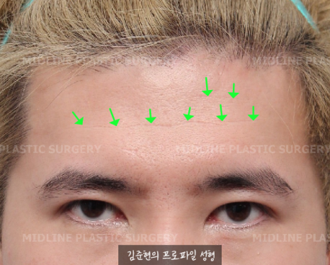 눈썹을 위로 올리는 습관으로 생긴 깊은 이마 주름이 고민이에요. 해결 방법은?(Feat. 이마거상 + 주름 필러) 관련 이미지 2
