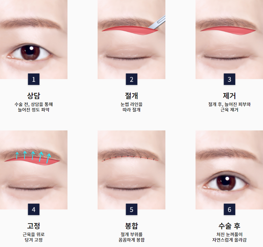눈과 눈썹 사이가 가깝고 눈꺼풀이 처져 답답해보여요ㅠㅠ이마거상으로 해결가능합니다. (Feat. 눈밑지방재배치 + 지방이식) 관련 이미지 3